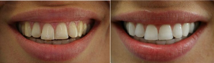 Kit de blanchiment des dents pour bandes
