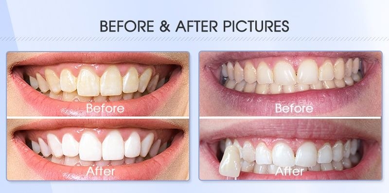 Two Patients use Pro Teeth Whitening Gel Kit used by Clinic Dentist