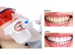 Blanchiment des dents rapide pour mes clients